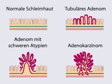 Adenom-Karzinom-Sequenz. User:Doktor silke / Wikimedia Commons, GFDL/CC-by-SA 3.0