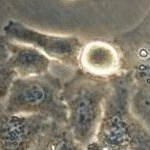 Krebszellen unter dem Mikroskop. UserAsd.and.Rizzo, via Wikimedia Commons, CC-vy-SA 3.0