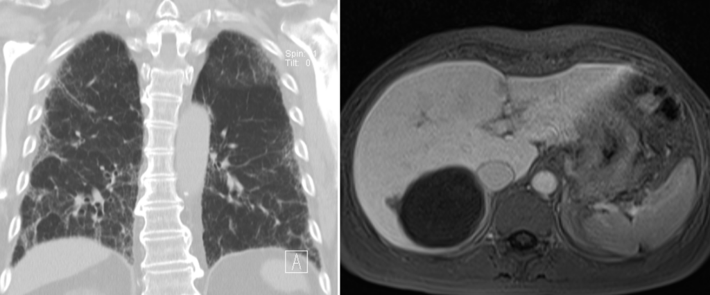 CT einer idiopathischen Lungenfibrose (links), MR einer verkalkten Raumforderung in der Leber (Echinococcus, links).
